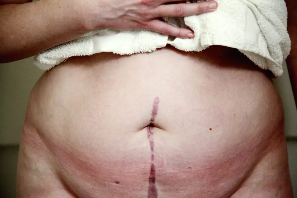 A healthy diet can help reduce recovery time and improve scarring.