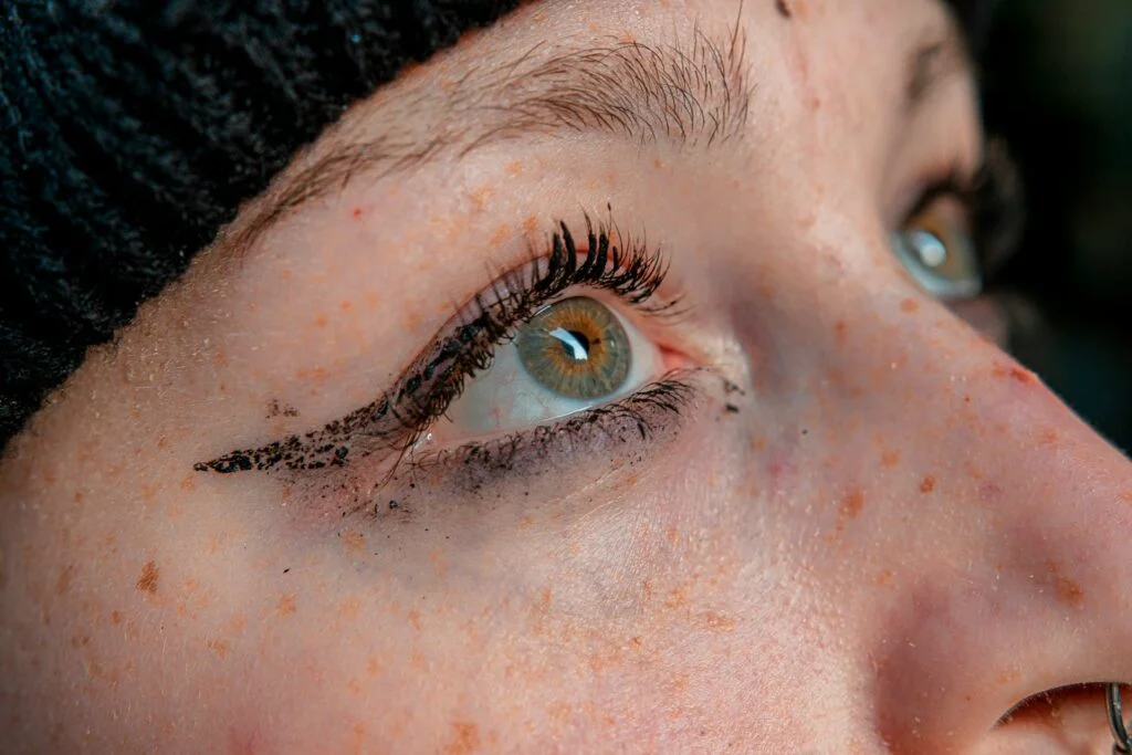 dark undereyes