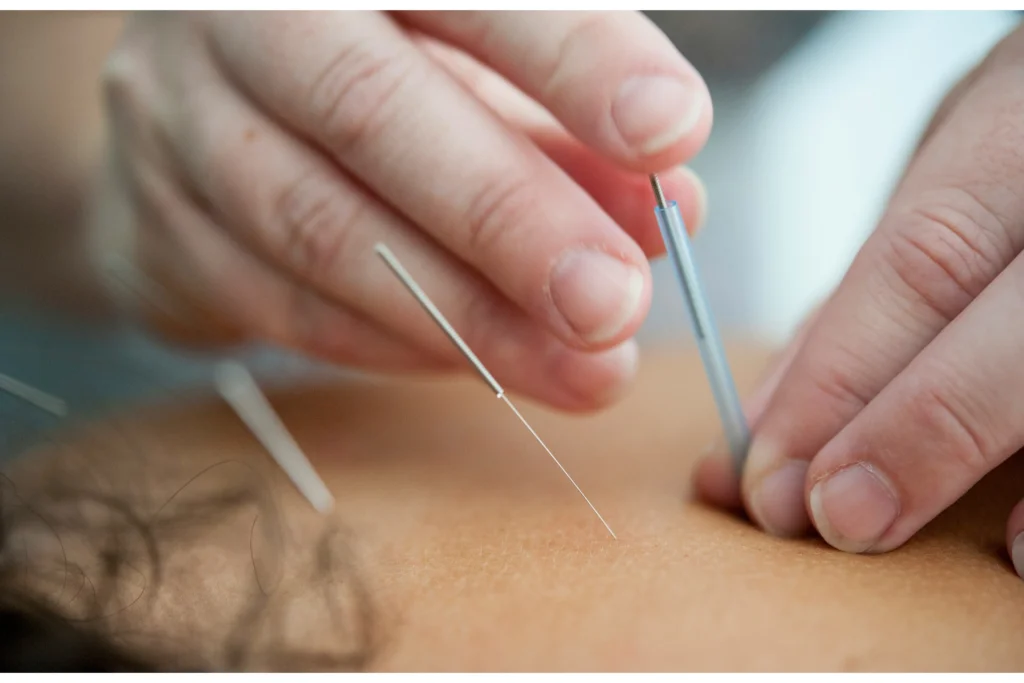 Acupuncture is one of the alternative methods that help encourage labor.