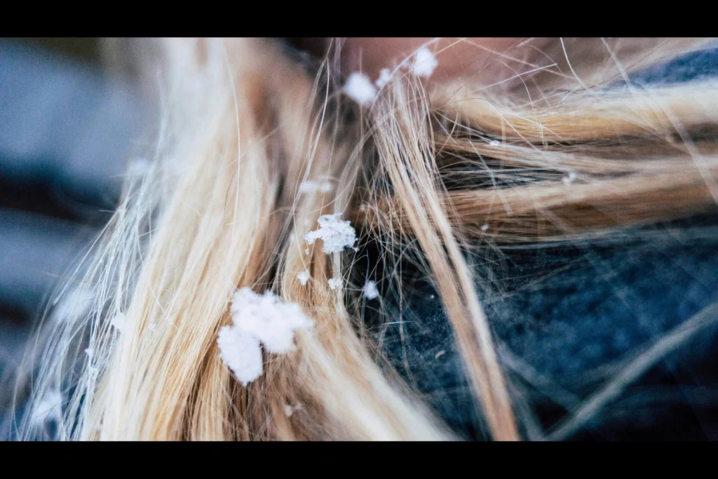a person with dandruff on their hair