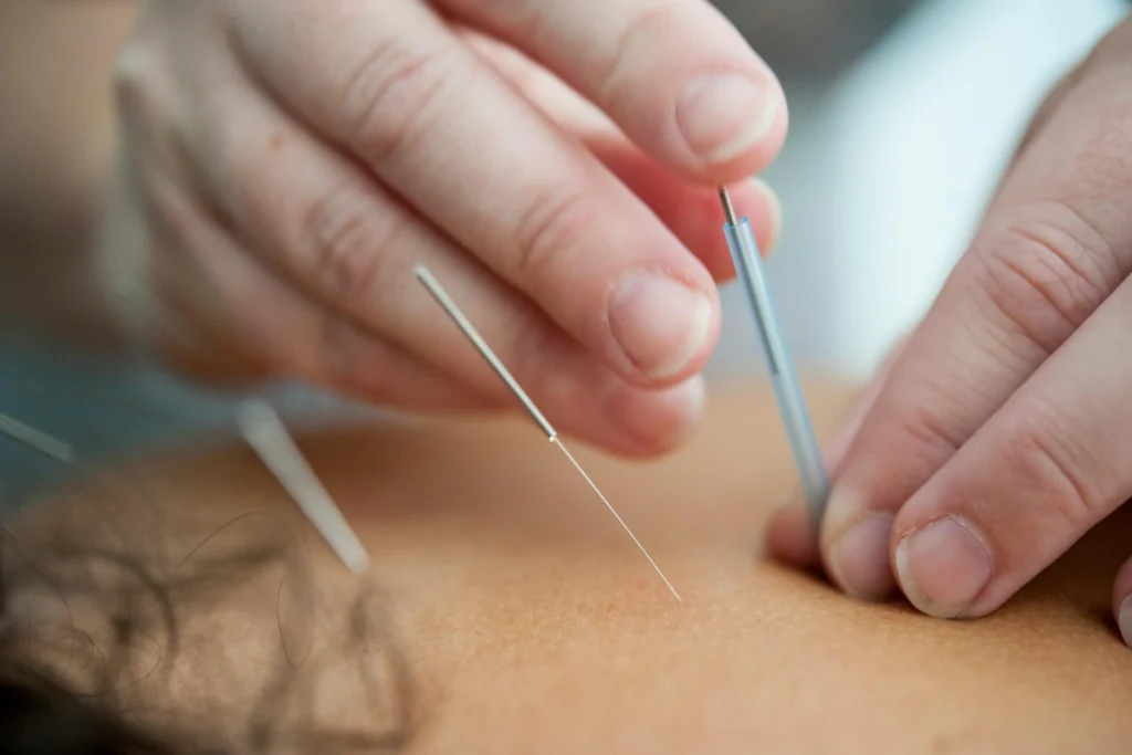 Close-up of thin acupuncture needles inserted into a person's skin
