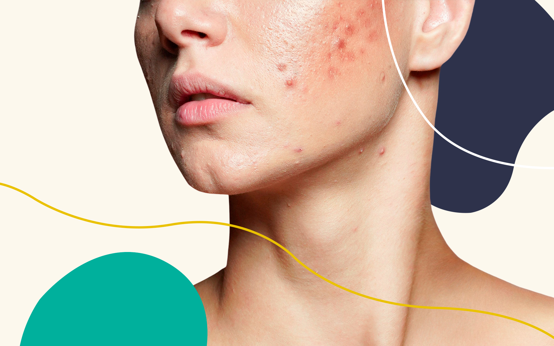 7 Tips for Taking Care of Acne Prone Skin in the Summer