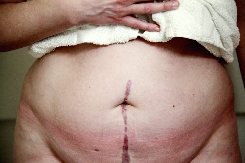 A healthy diet can help reduce recovery time and improve scarring.