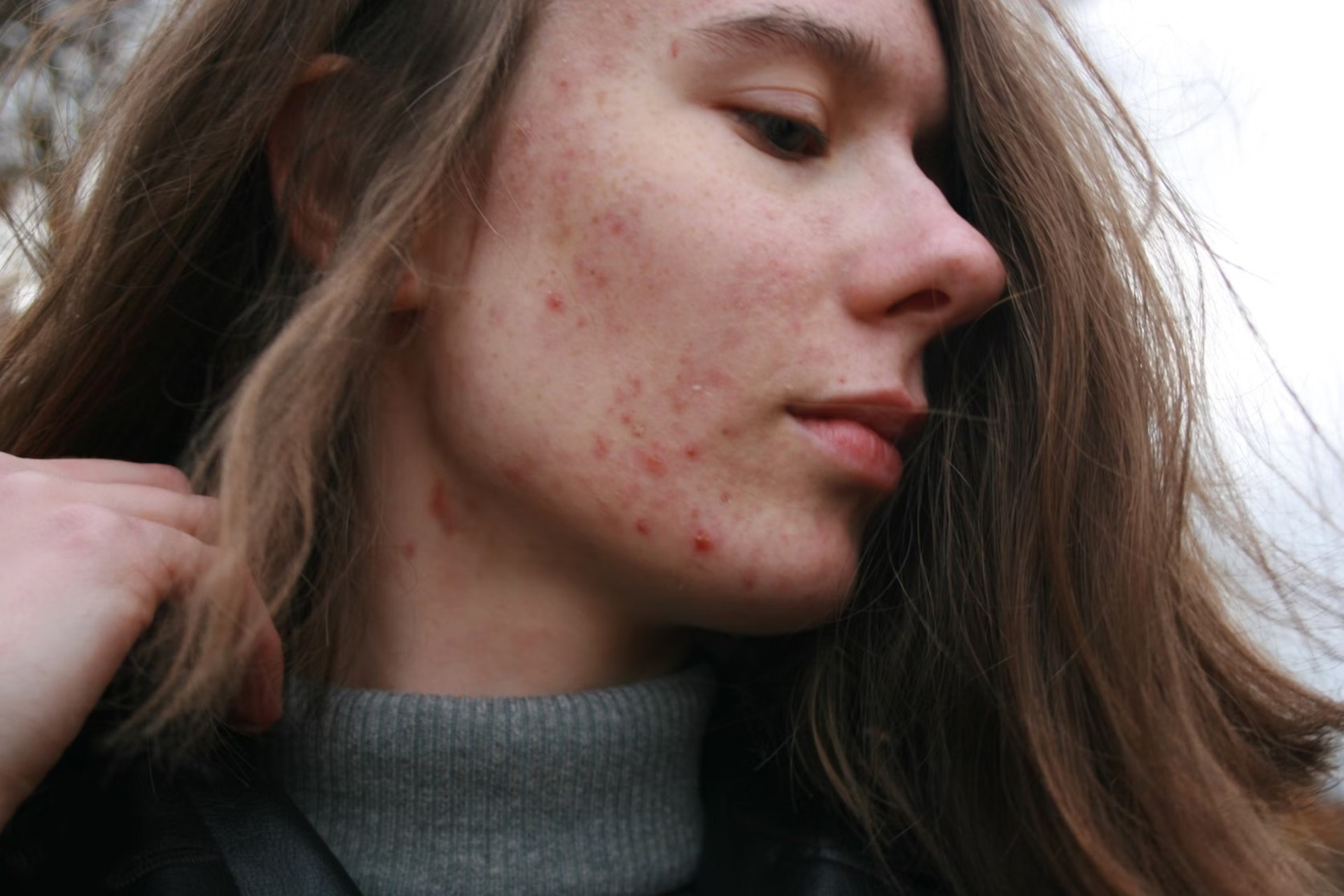 woman with acne