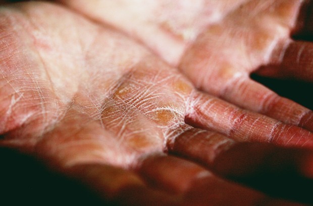 Dry skin makes hands look older.