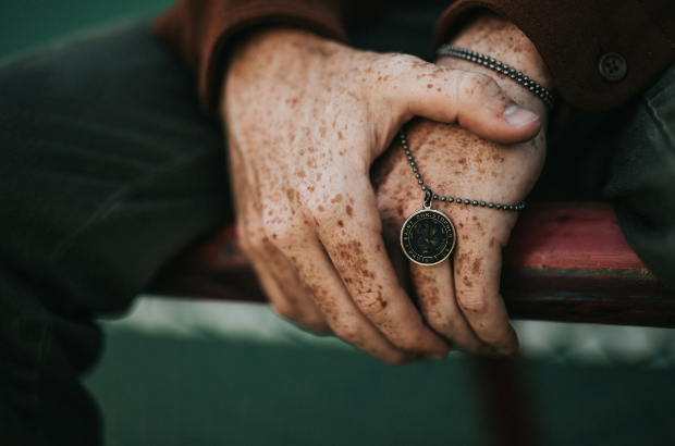 Age spots can make skin look older. 