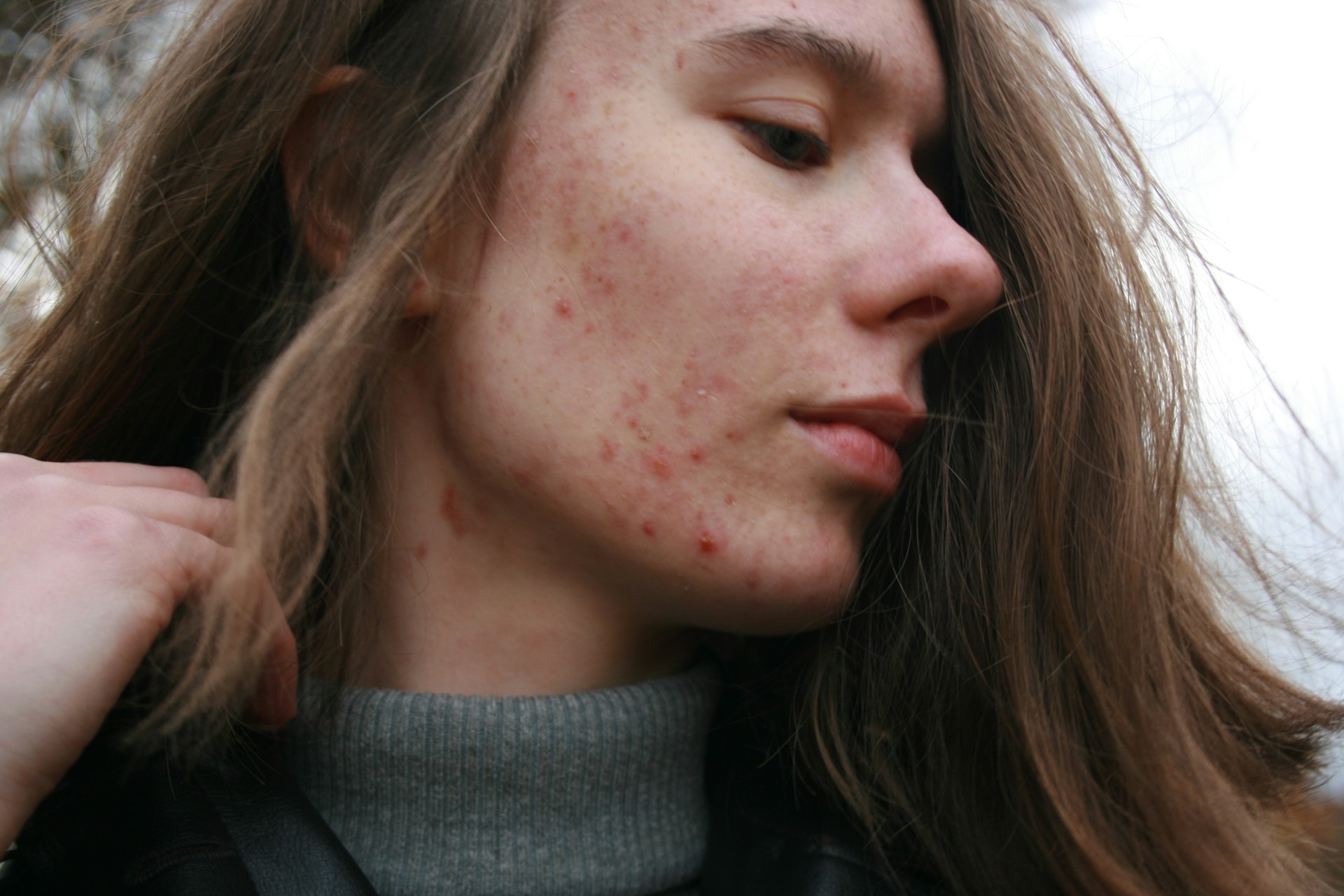 A beautiful woman with acne