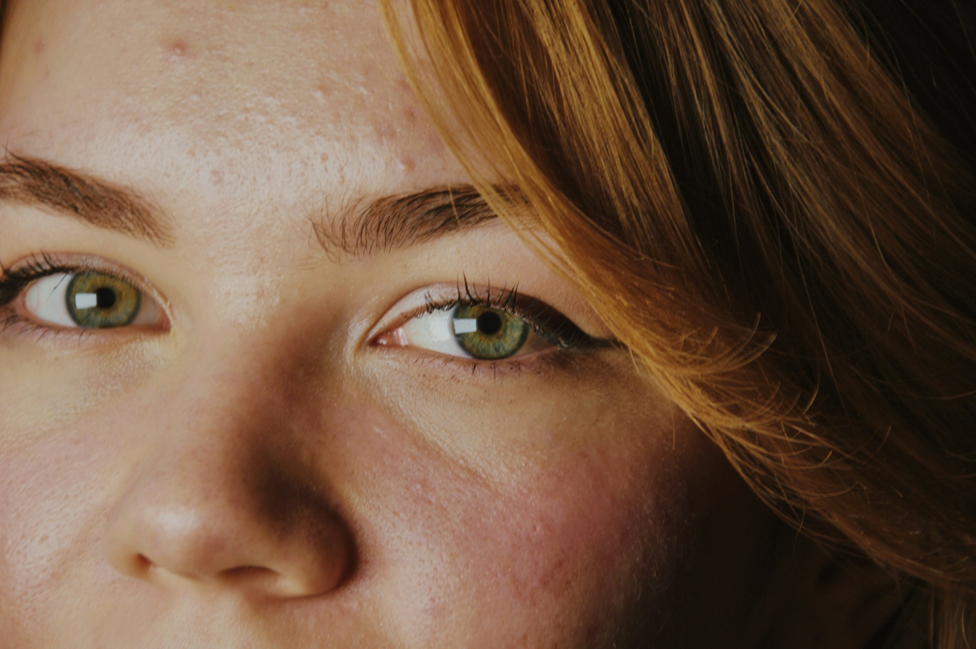 A beautiful woman with acne